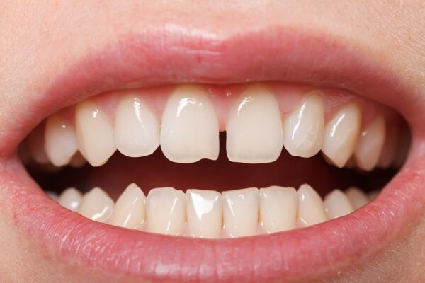 Can Dental Bonding Fix Your Front Teeth Gap?
